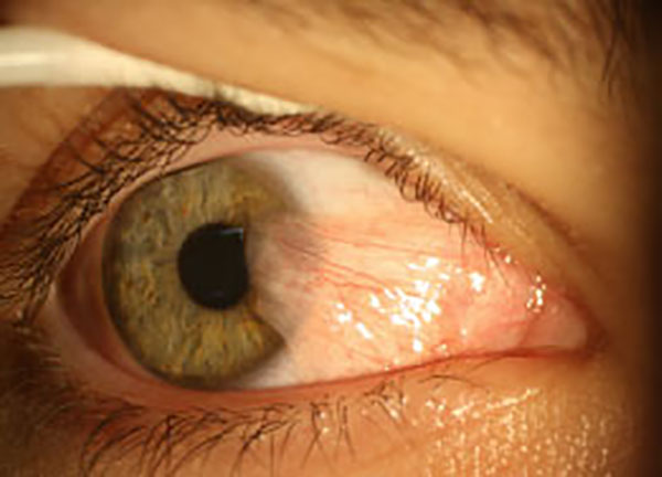 Pterygium